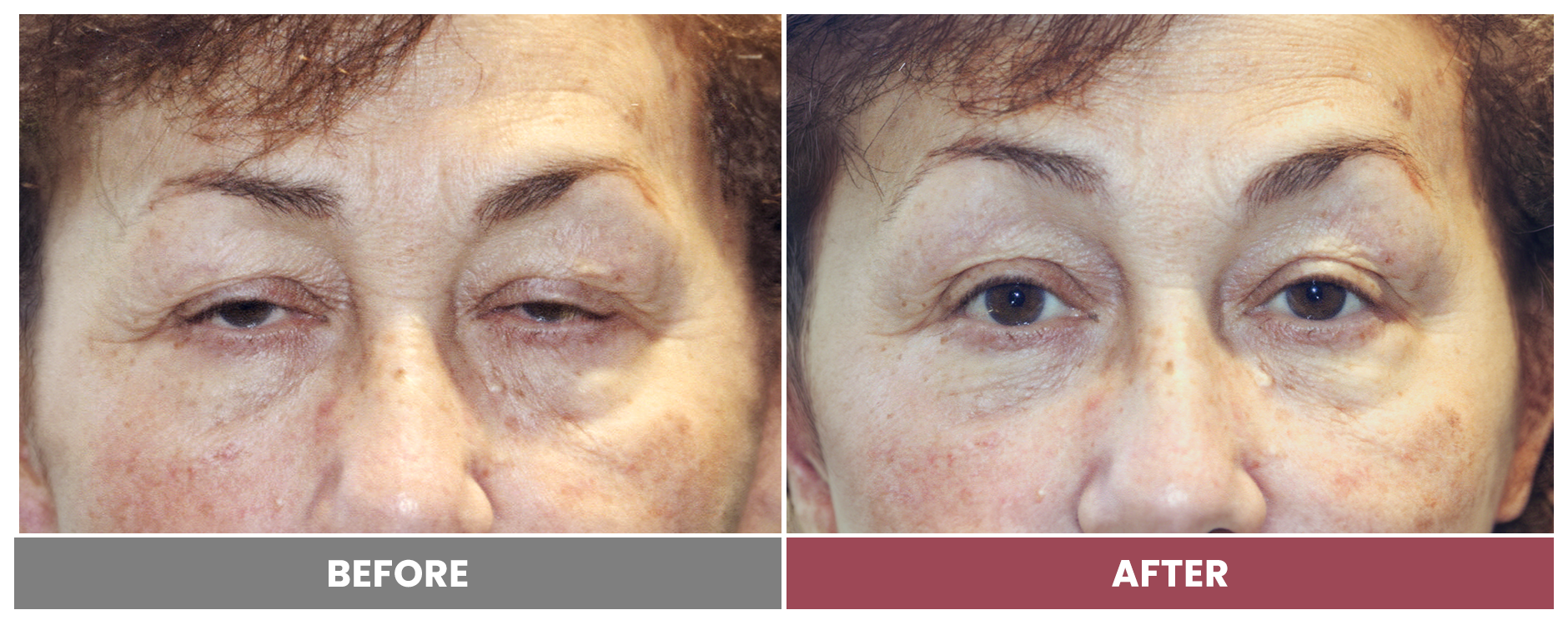 PTOSIS REPAIR - Case 44